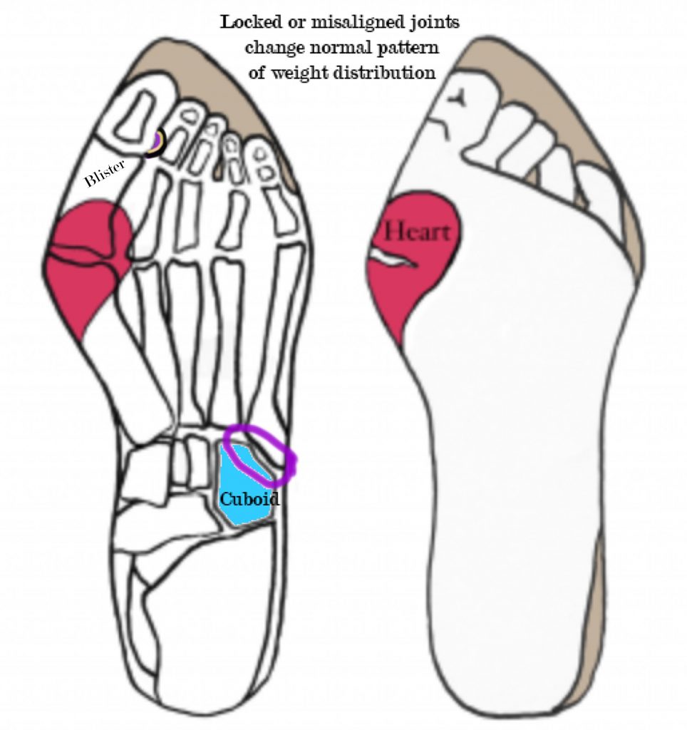 Releasing Tension Causing Bunion « Put Your Best Feet Forward